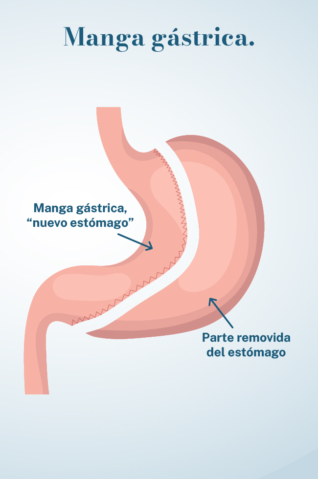 Manga Gástrica en Cuernavaca